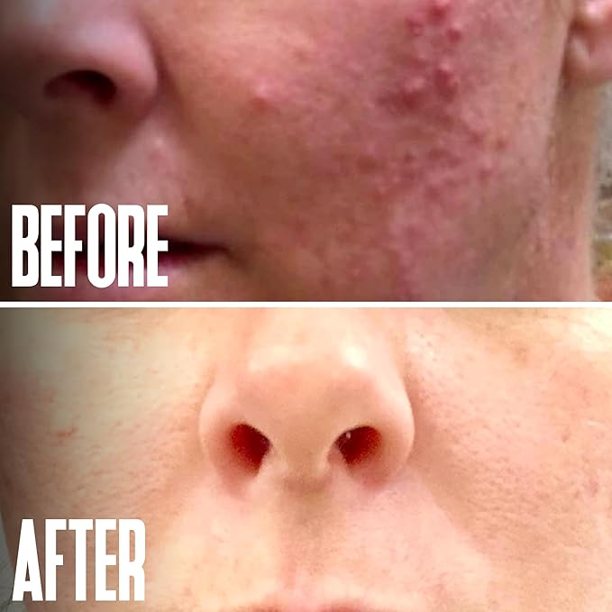 Glycolic Acid Peel 40% Professional Chemical Peel for Face for Acne Scars, Collagen Boost, Wrinkles, Fine Lines - Alpha Hydroxy Acid Liquid Exfoliant for Face Peel Mask for Men & Women
