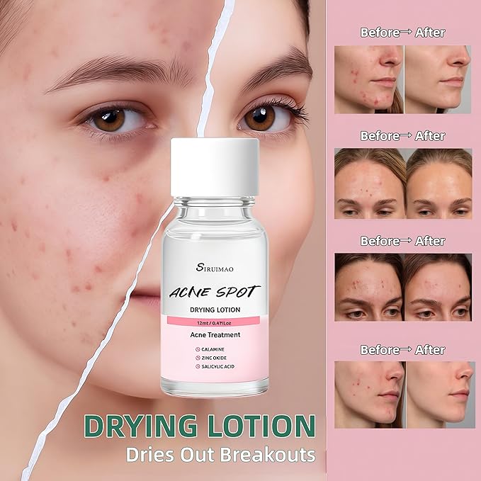 Premium Acne Spot Drying Lotion Kit with Swab, Overnight Acne Treatment For Face, Dry Out Pimples, Blemishes, Zits And Clean Pores, 12ml / 0.41 FlOz